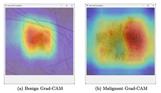 III. Melanoma Detection